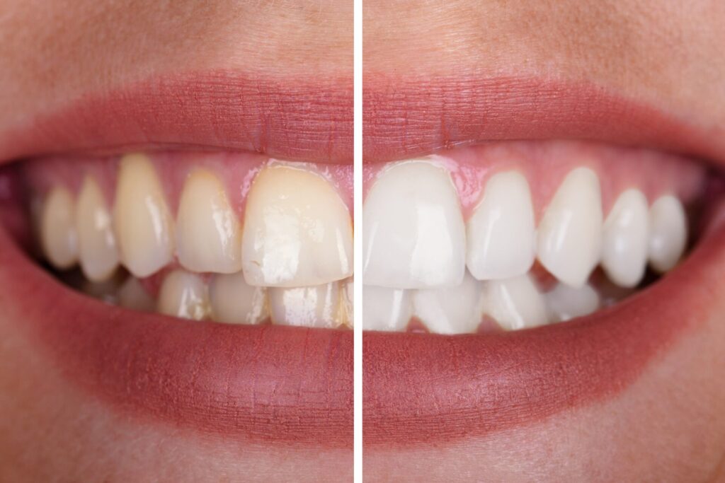 Teeth Whitening Dee Why 
